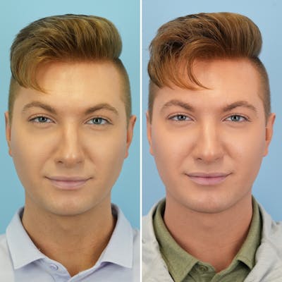 Chin Implant Before & After Gallery - Patient 190693 - Image 1