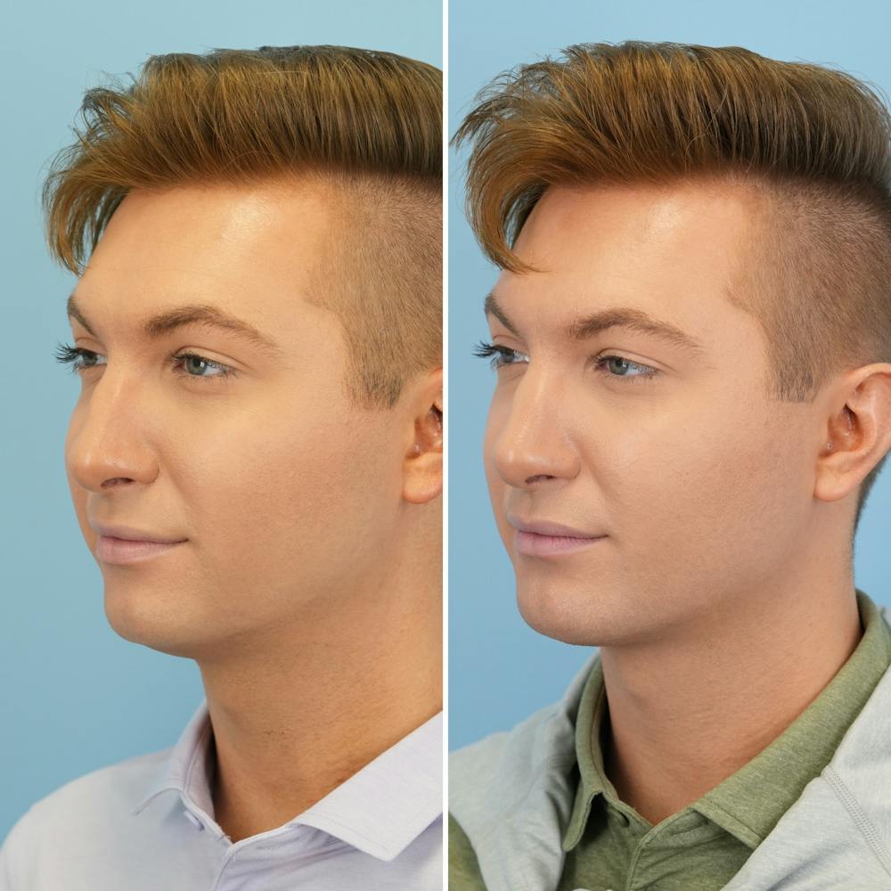 Chin Implant Before & After Gallery - Patient 190693 - Image 4