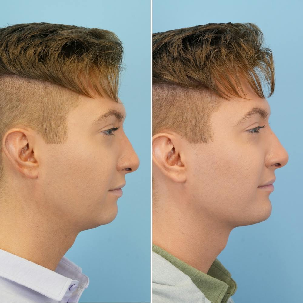 Chin Implant Before & After Gallery - Patient 190693 - Image 3