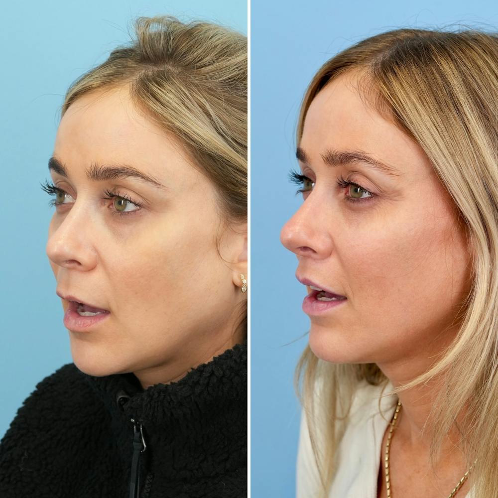 Lip Lift Before & After Gallery - Patient 471916 - Image 6
