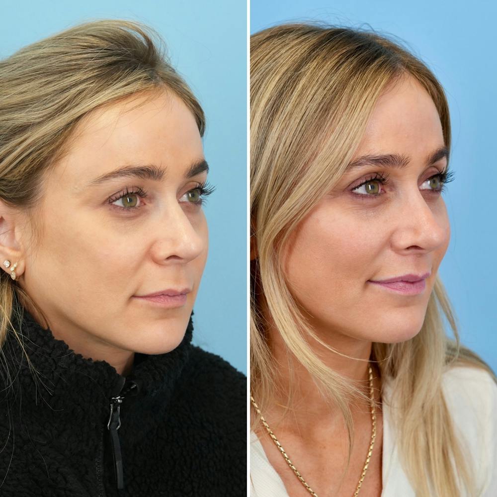 Lip Lift Before & After Gallery - Patient 471916 - Image 3