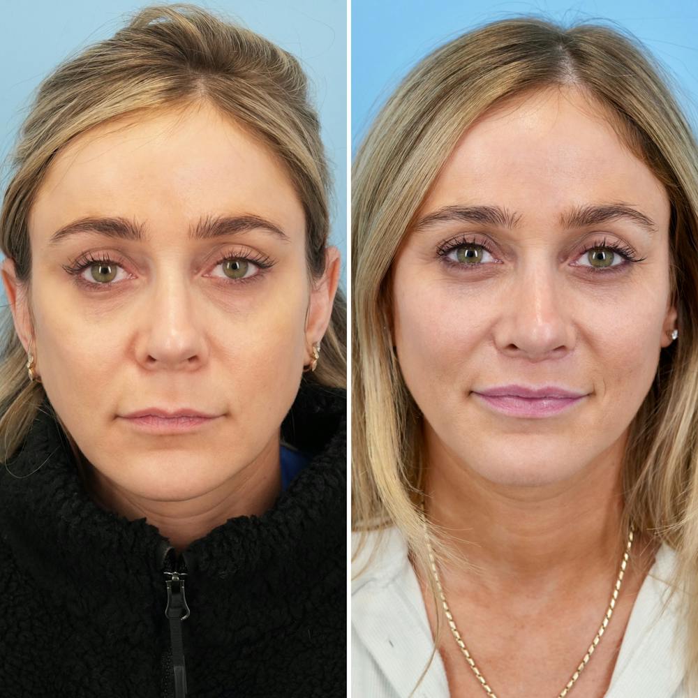 Lip Lift Before & After Gallery - Patient 471916 - Image 1