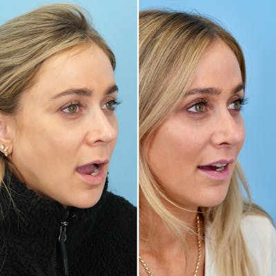 Lip Lift Before & After Gallery - Patient 471916 - Image 4