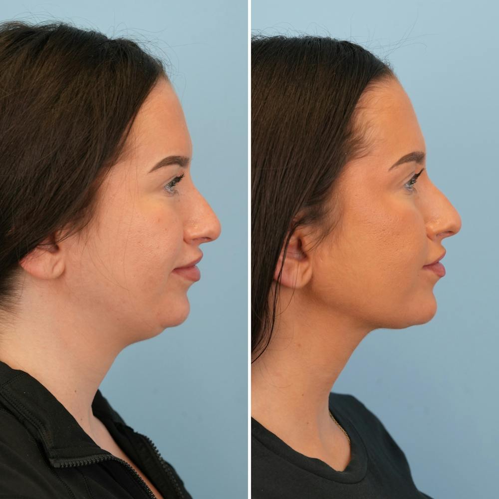 Submental Liposuction Before & After Gallery - Patient 841155 - Image 5