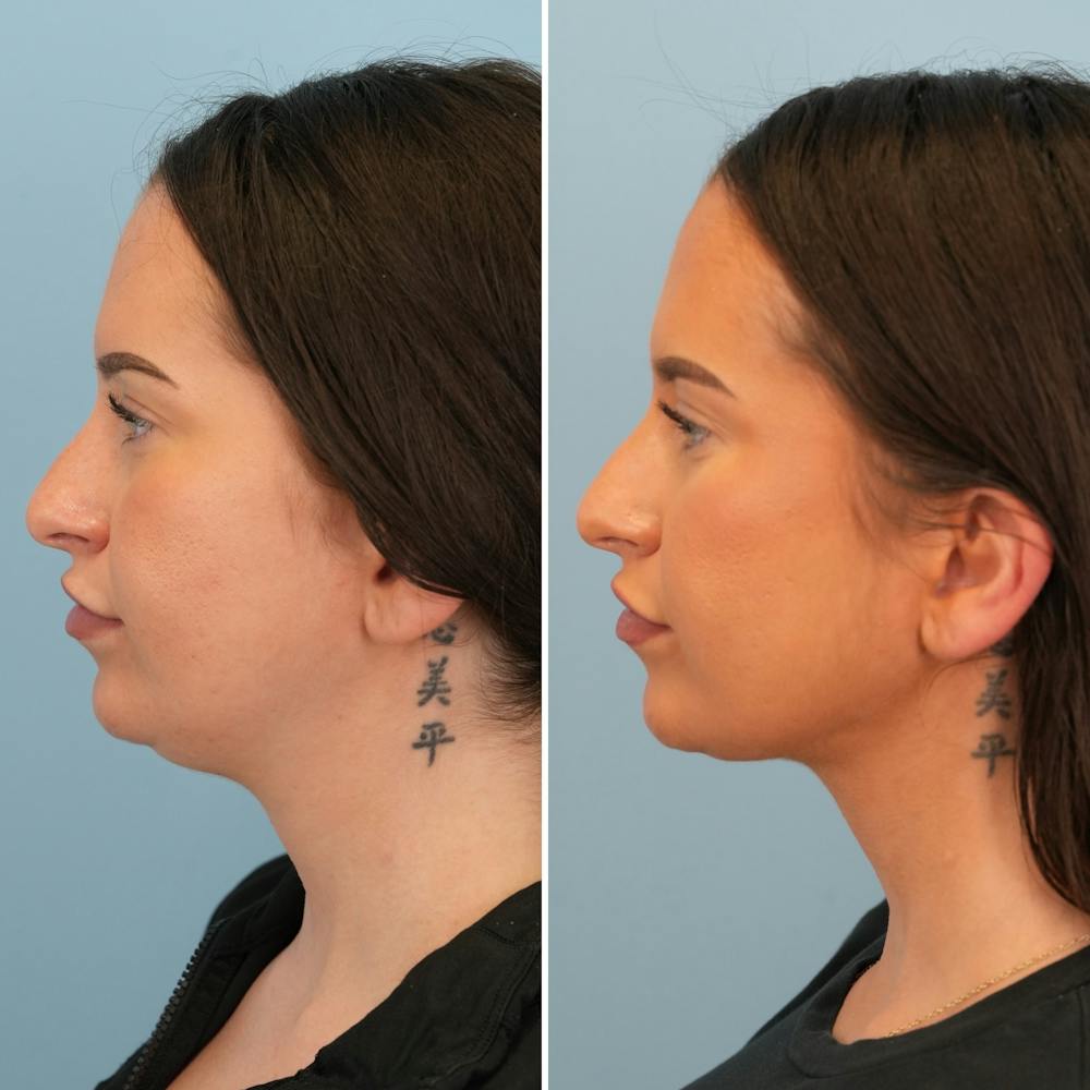Submental Liposuction Before & After Gallery - Patient 841155 - Image 1