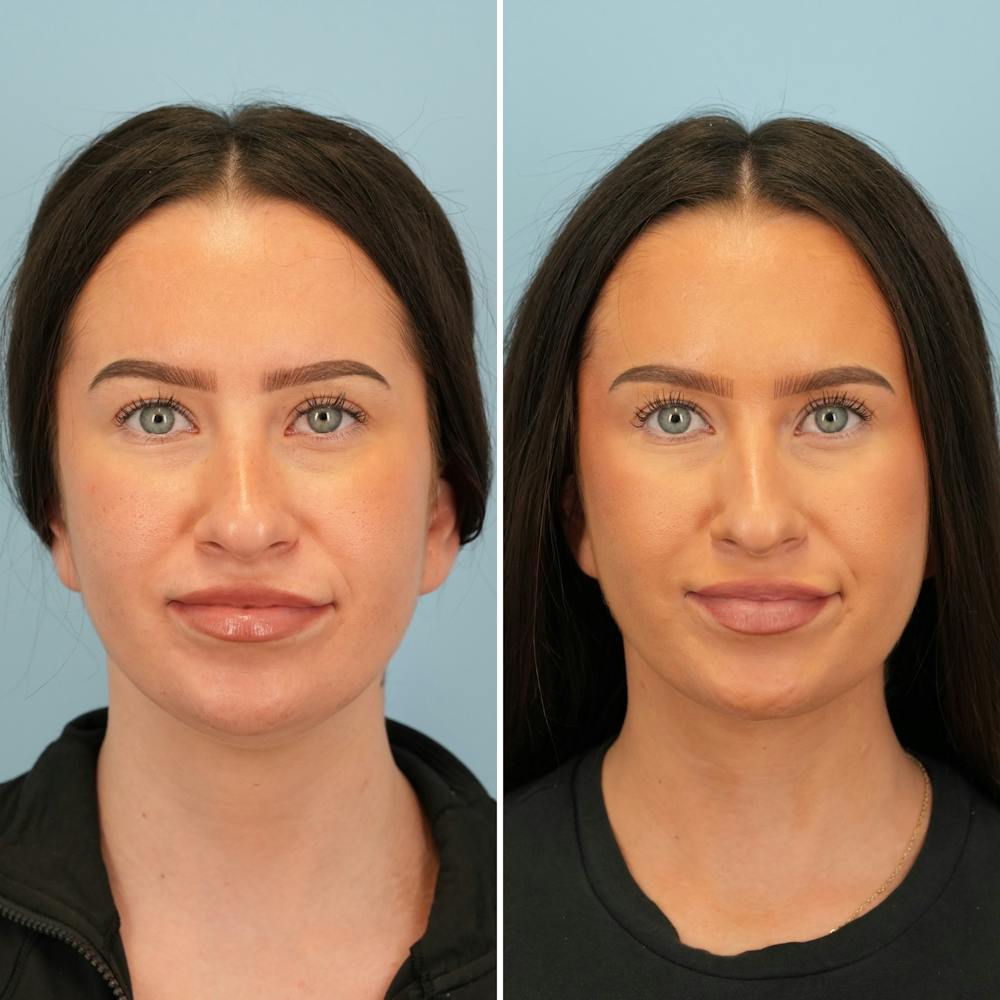 Submental Liposuction Before & After Gallery - Patient 841155 - Image 3