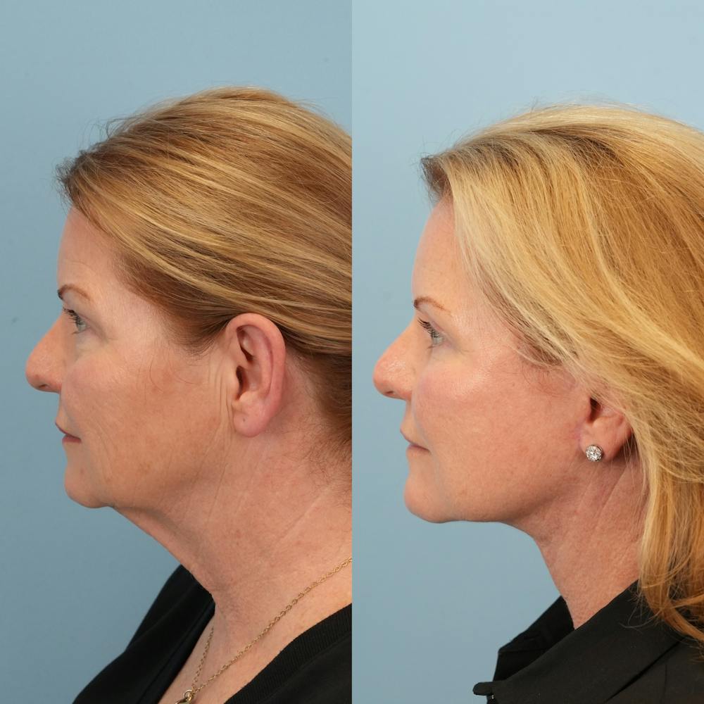 Neck Lift Before & After Gallery - Patient 563422 - Image 5