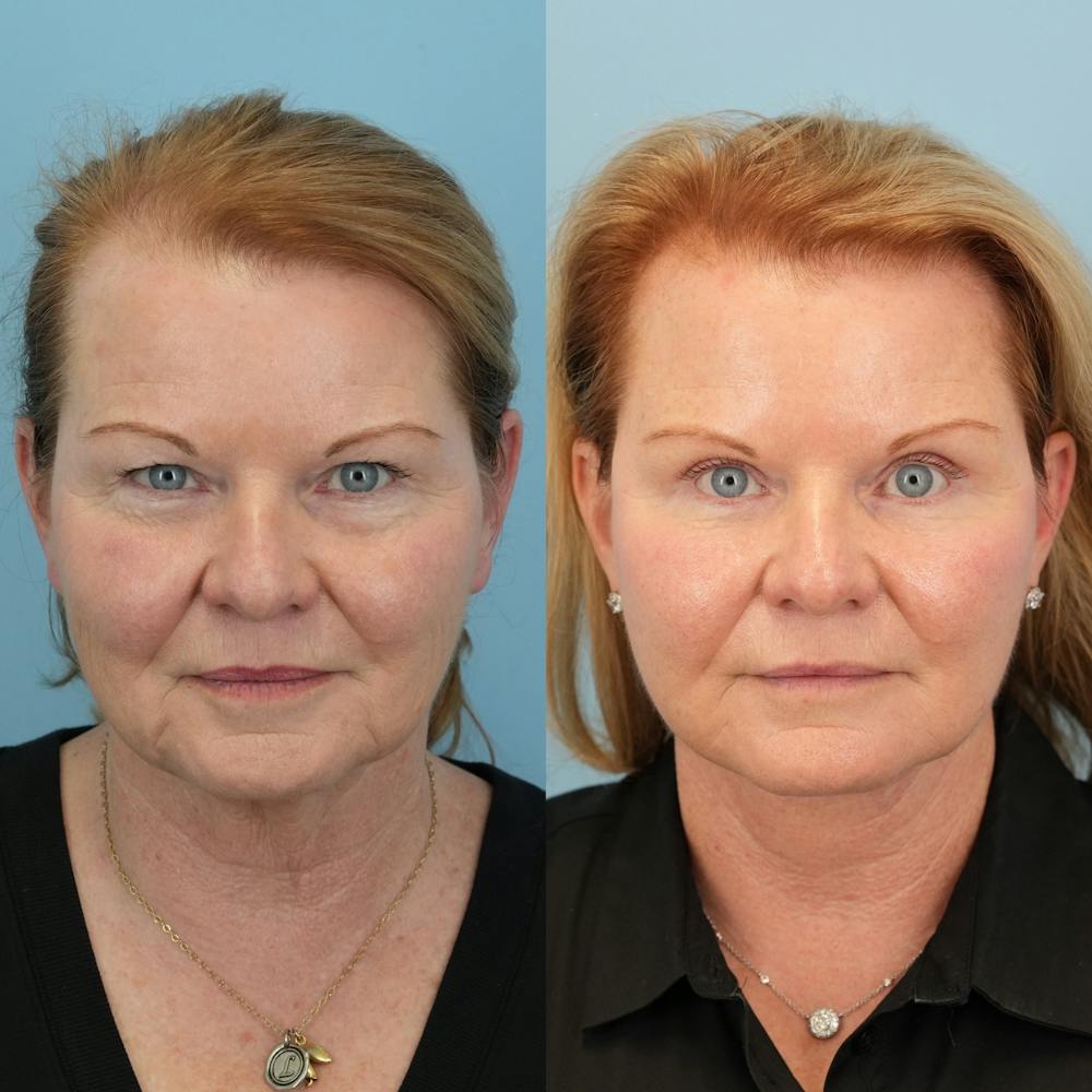 Neck Lift Before & After Gallery - Patient 563422 - Image 3