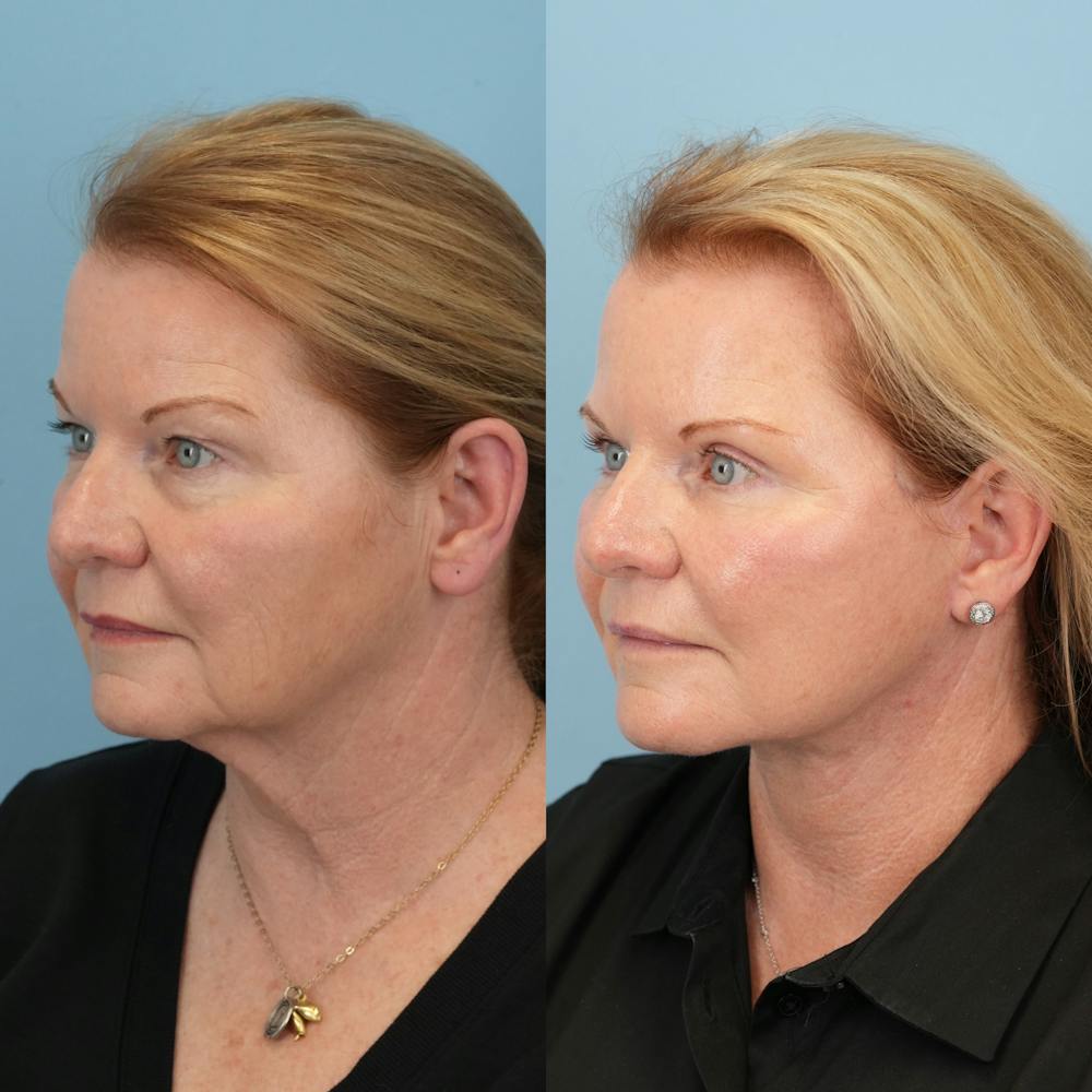 Neck Lift Before & After Gallery - Patient 563422 - Image 4
