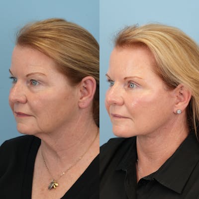 Neck Lift Before & After Gallery - Patient 563422 - Image 4