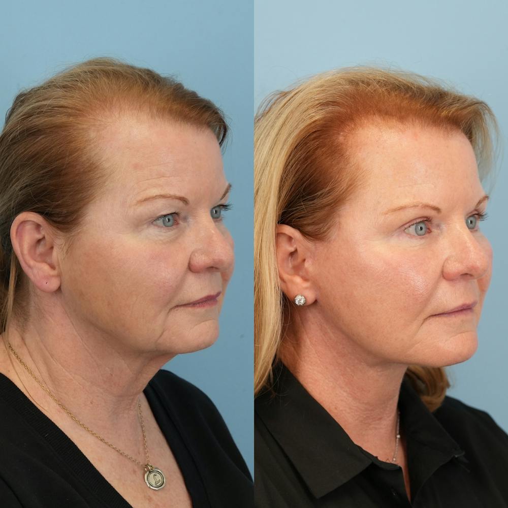 Neck Lift Before & After Gallery - Patient 563422 - Image 2