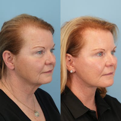 Neck Lift Before & After Gallery - Patient 563422 - Image 2