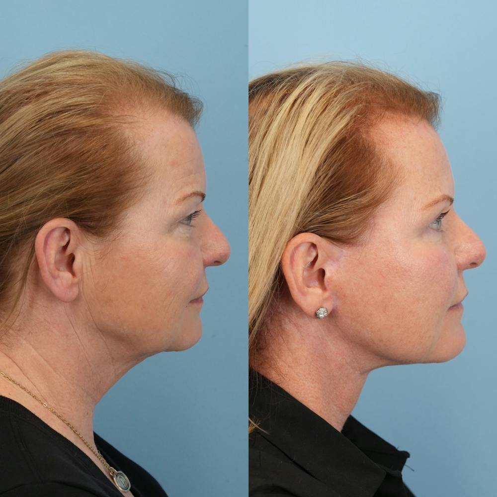 Neck Lift Before & After Gallery - Patient 563422 - Image 1