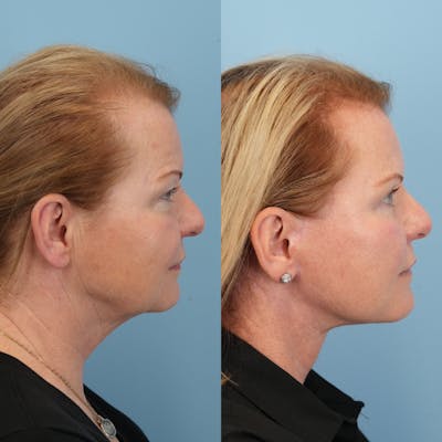 Neck Lift Before & After Gallery - Patient 563422 - Image 1