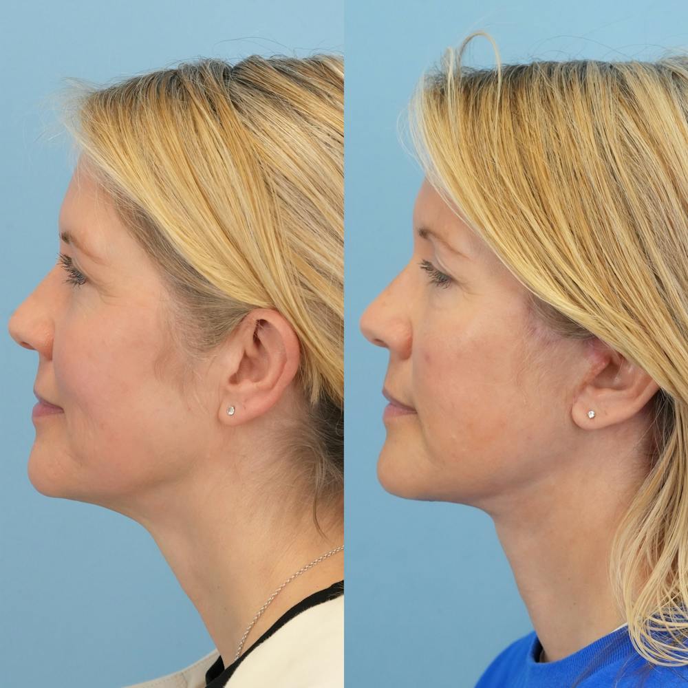 Lower Eyelids Before & After Gallery - Patient 341885 - Image 5