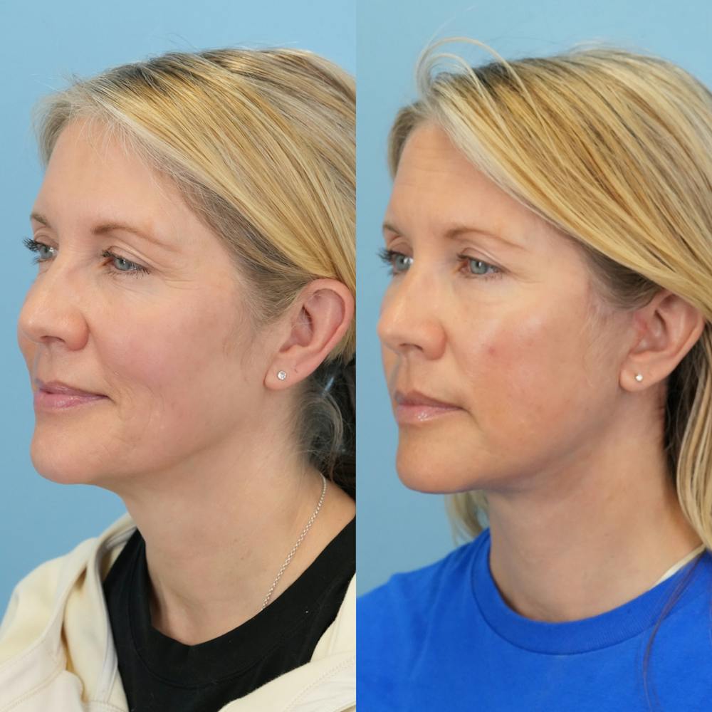 Lower Eyelids Before & After Gallery - Patient 341885 - Image 4