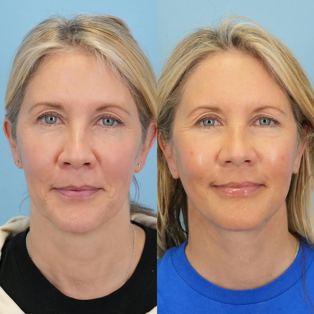 Lower Eyelids Before & After Gallery - Patient 341885 - Image 1