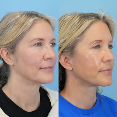 Lower Eyelids Before & After Gallery - Patient 341885 - Image 2