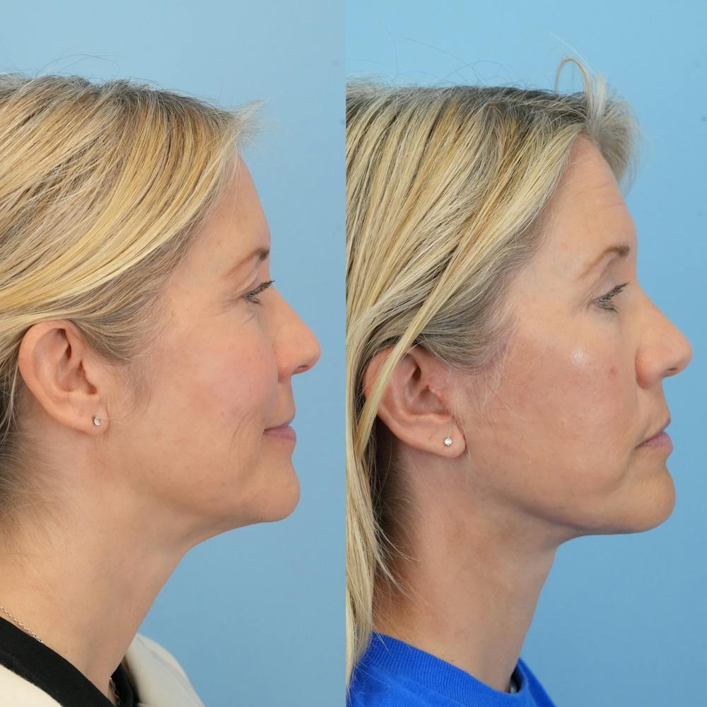 Lower Eyelids Before & After Gallery - Patient 341885 - Image 3