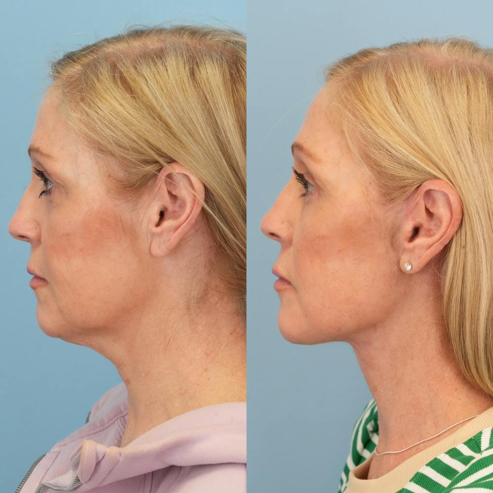 Lower Eyelids Before & After Gallery - Patient 230930 - Image 5