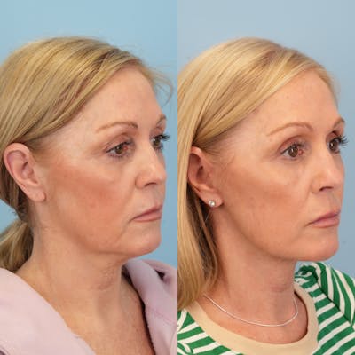 Lower Eyelids Before & After Gallery - Patient 230930 - Image 2