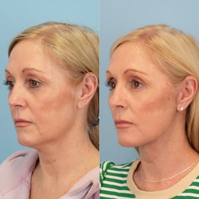 Lower Eyelids Before & After Gallery - Patient 230930 - Image 4