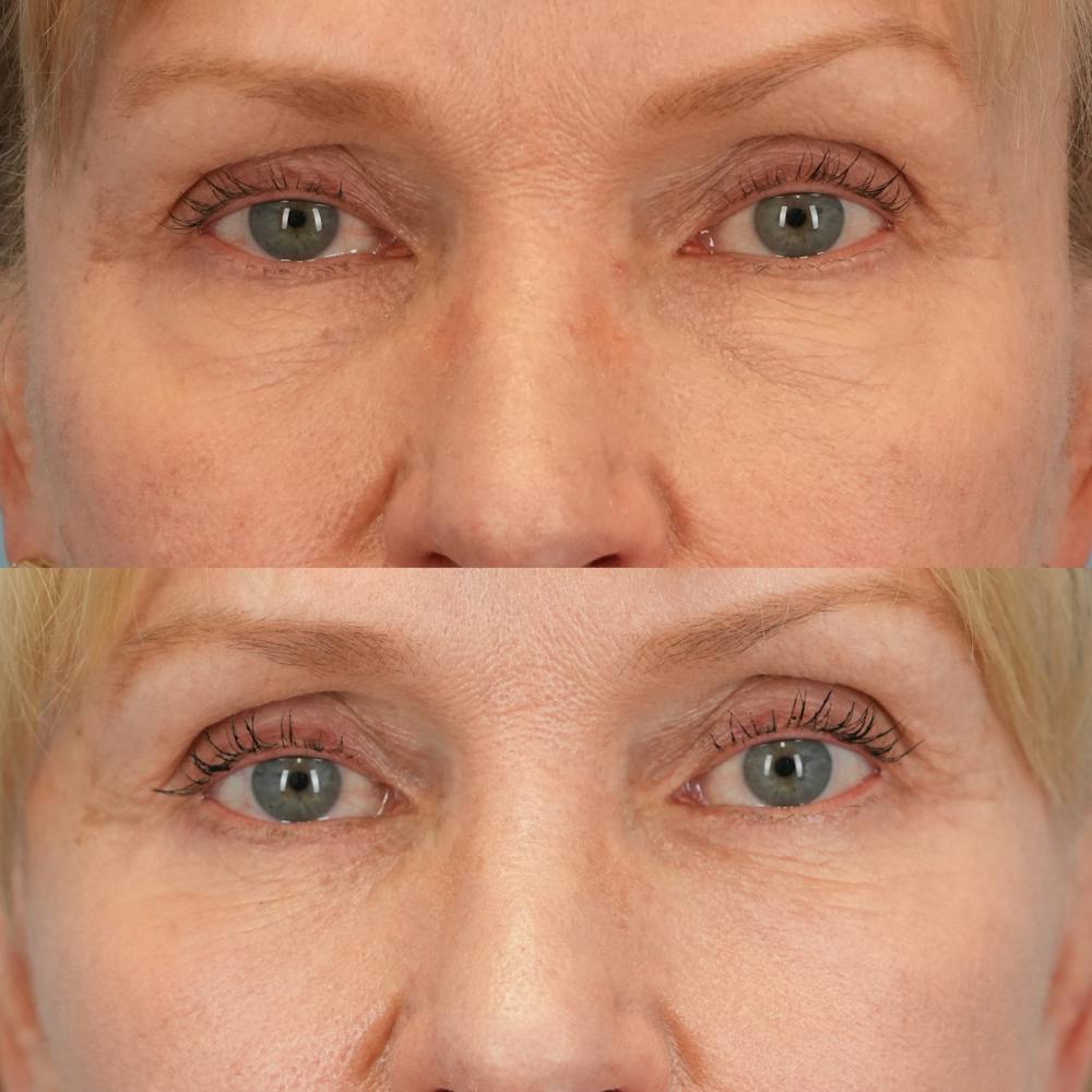 Lower Eyelids Before & After Gallery - Patient 218637 - Image 1