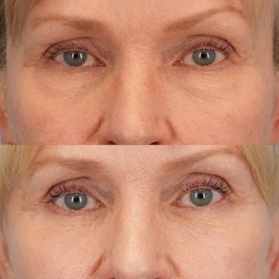 Lower Eyelids Before & After Gallery - Patient 218637 - Image 1
