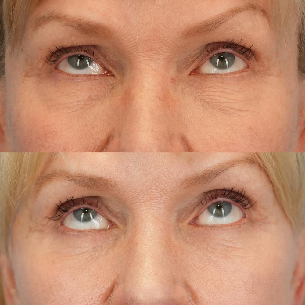 Lower Eyelids Before & After Gallery - Patient 218637 - Image 2