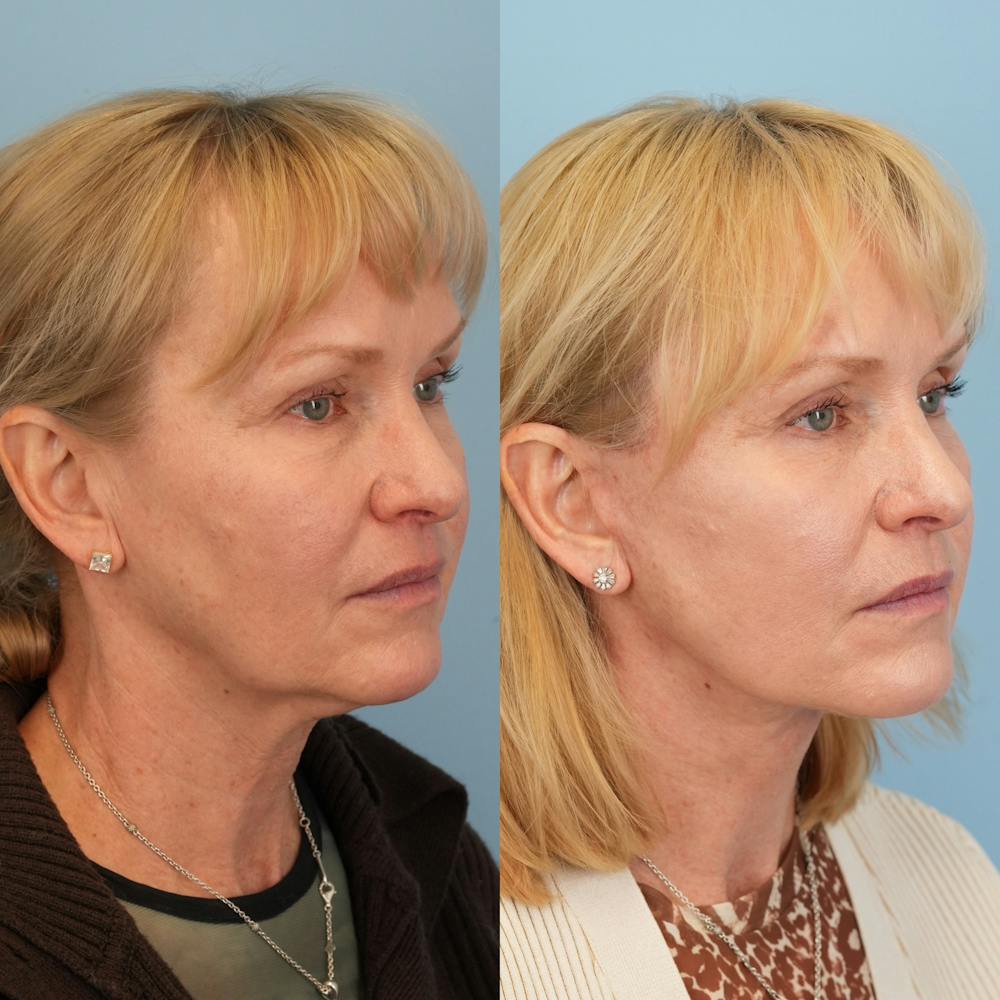 Lower Eyelids Before & After Gallery - Patient 218637 - Image 4