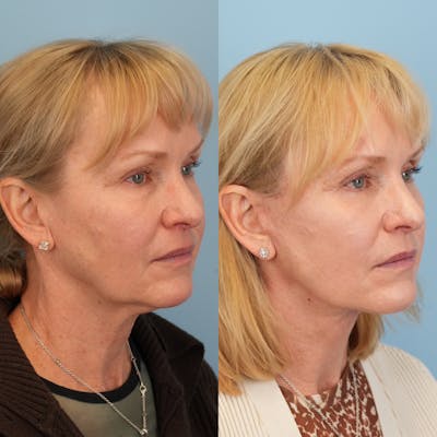 Lower Eyelids Before & After Gallery - Patient 218637 - Image 4
