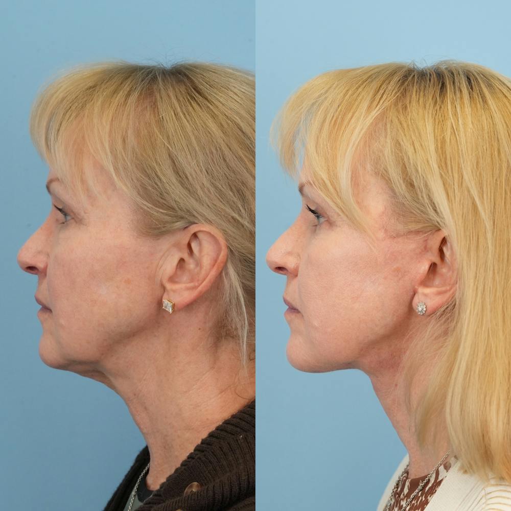 Lower Eyelids Before & After Gallery - Patient 218637 - Image 7