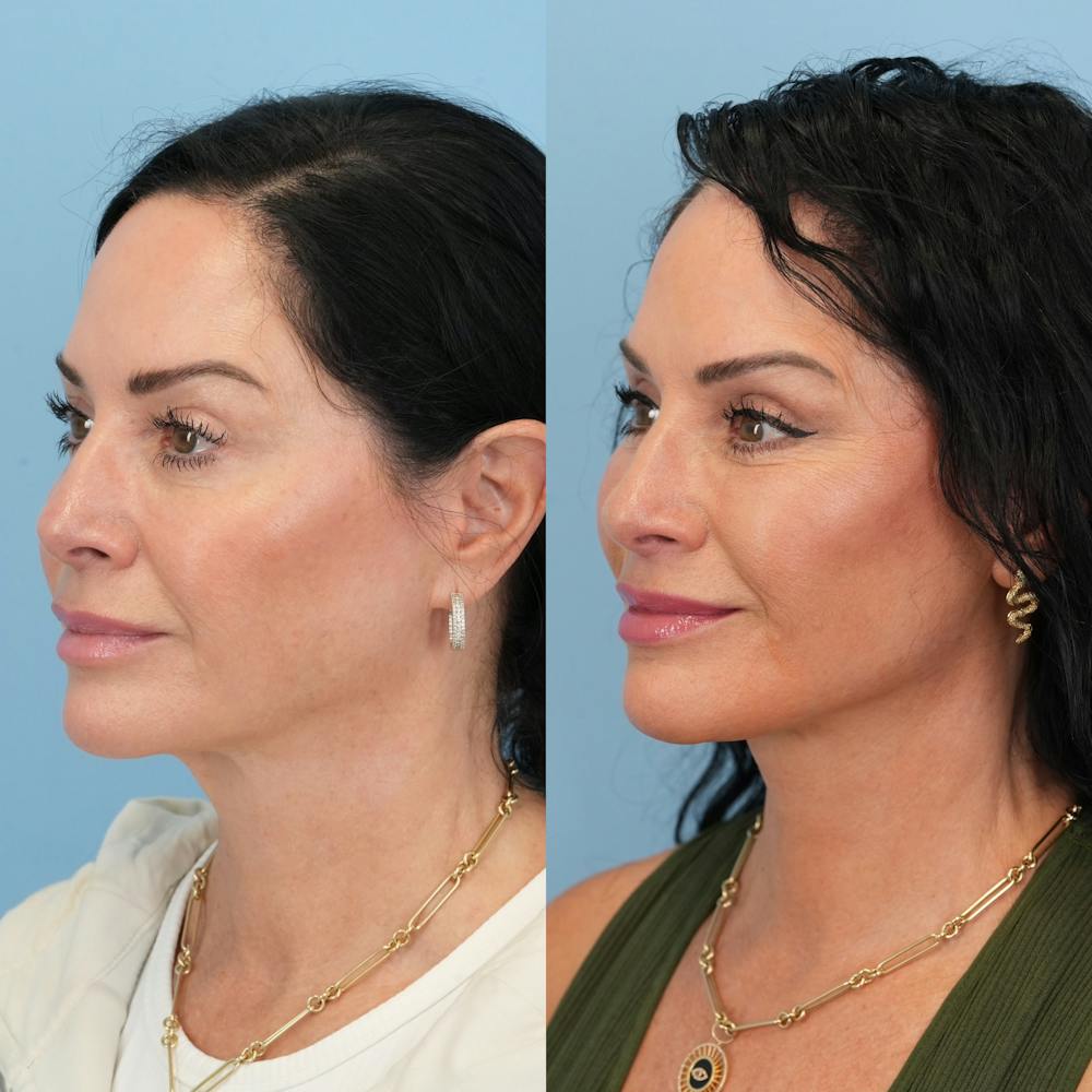 Lower Eyelids Before & After Gallery - Patient 239206 - Image 5