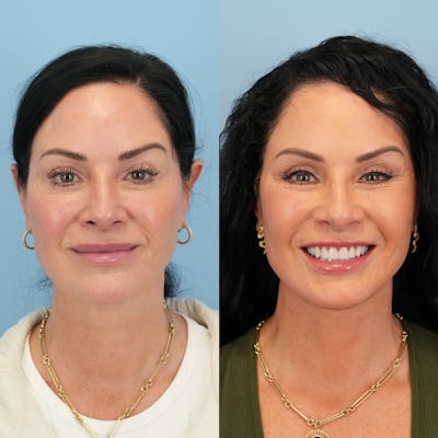 Lower Eyelids Before & After Gallery - Patient 239206 - Image 2