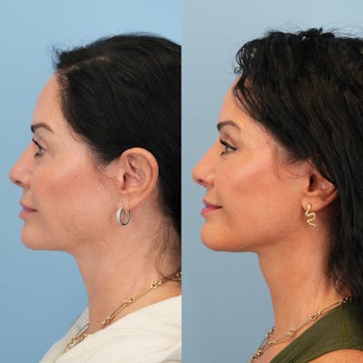 Lower Eyelids Before & After Gallery - Patient 239206 - Image 6