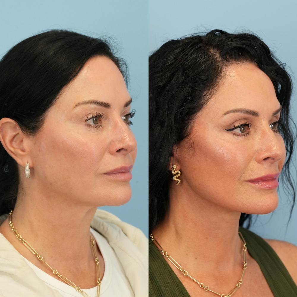 Lower Eyelids Before & After Gallery - Patient 239206 - Image 3