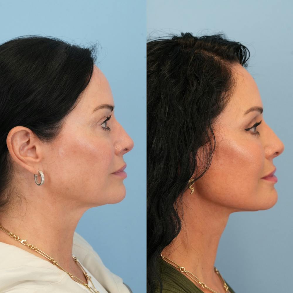 Lower Eyelids Before & After Gallery - Patient 239206 - Image 4