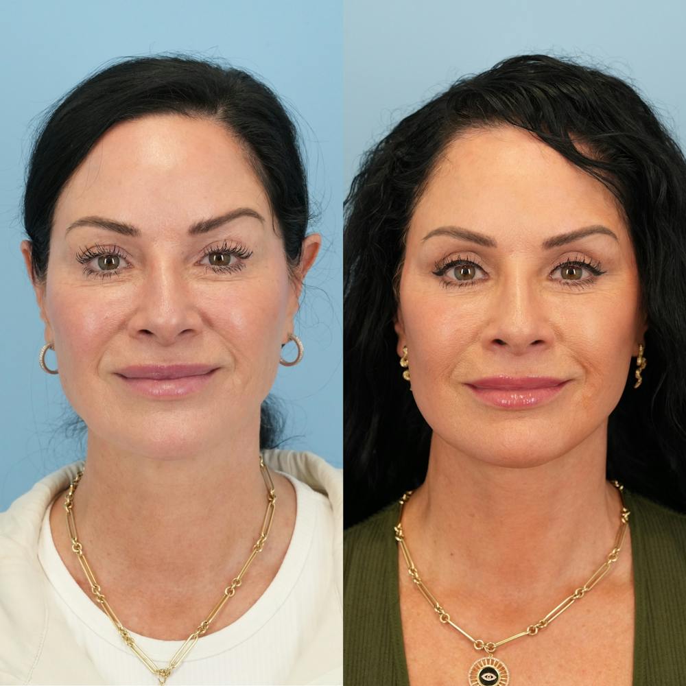 Lower Eyelids Before & After Gallery - Patient 239206 - Image 1