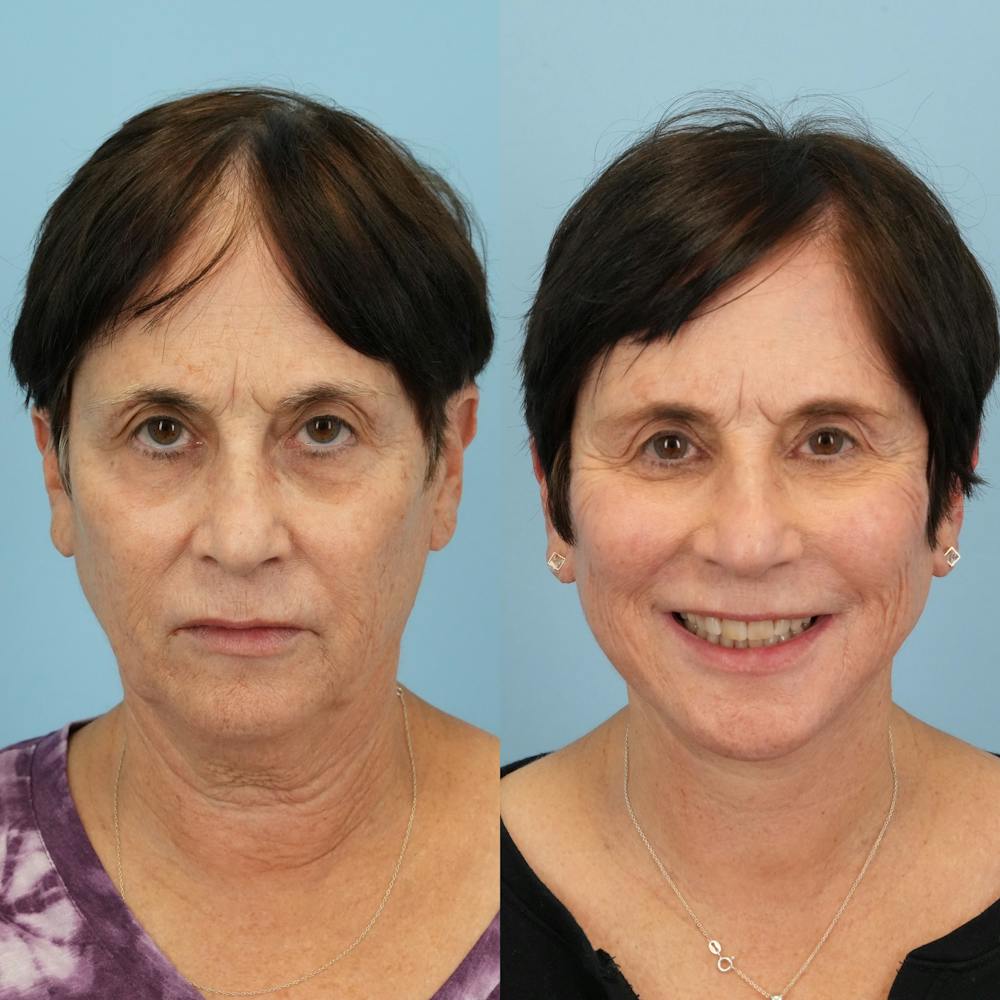 Lower Eyelids Before & After Gallery - Patient 183866 - Image 2
