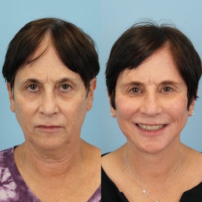Lower Eyelids Before & After Gallery - Patient 183866 - Image 2