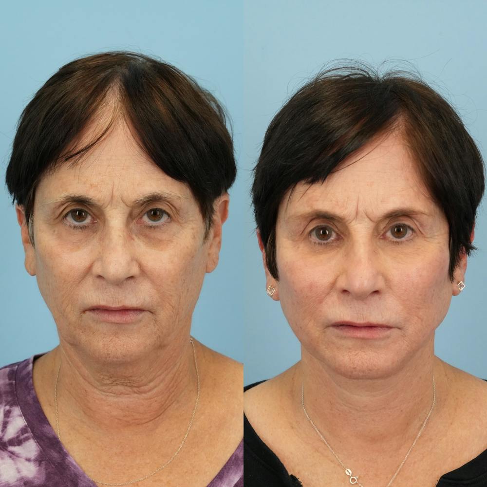 Lower Eyelids Before & After Gallery - Patient 183866 - Image 1