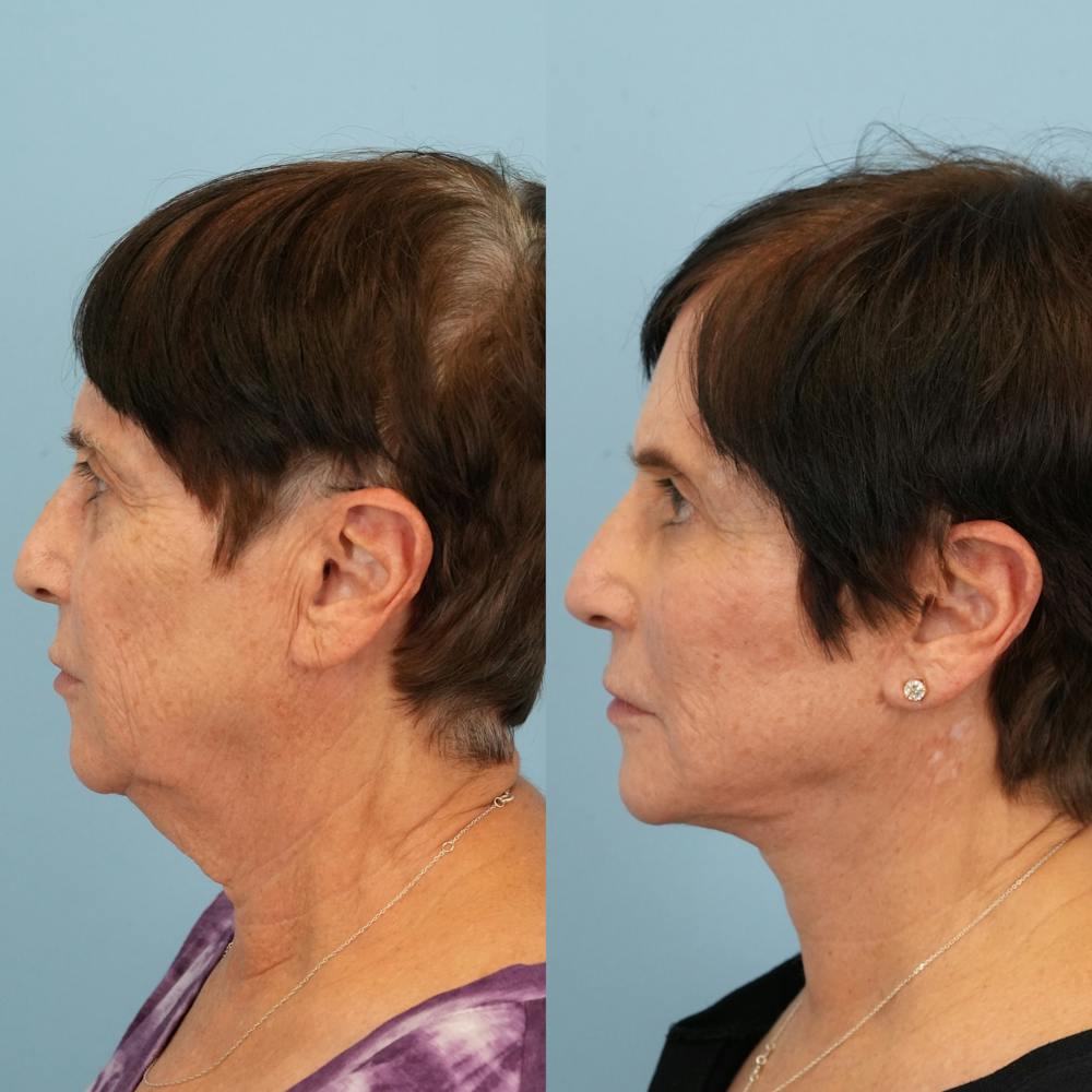 Lower Eyelids Before & After Gallery - Patient 183866 - Image 6