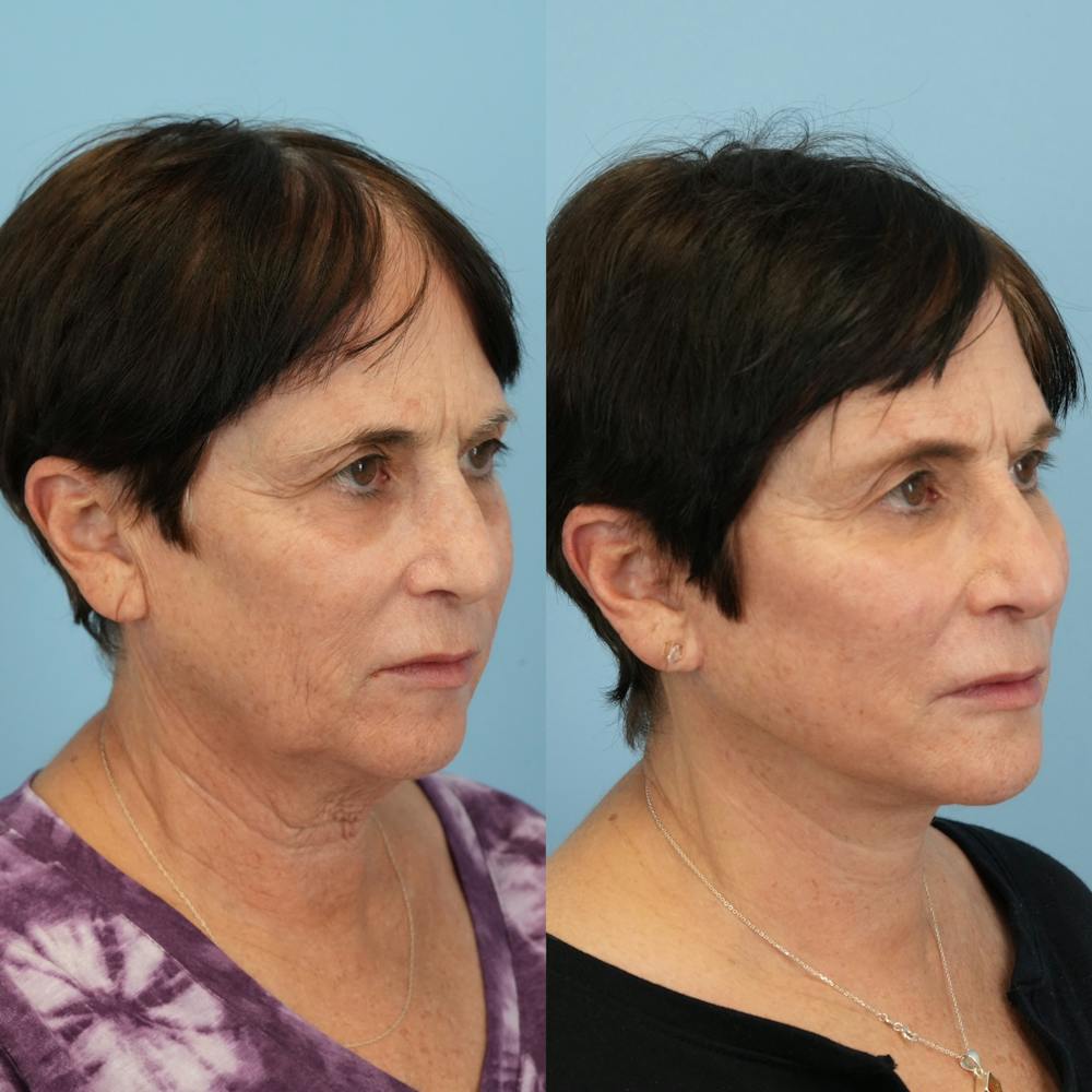 Lower Eyelids Before & After Gallery - Patient 183866 - Image 3
