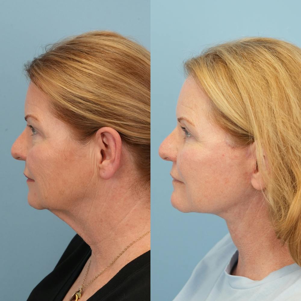 Upper Eyelids Before & After Gallery - Patient 263021 - Image 5