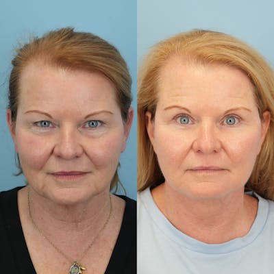 Upper Eyelids Before & After Gallery - Patient 263021 - Image 1