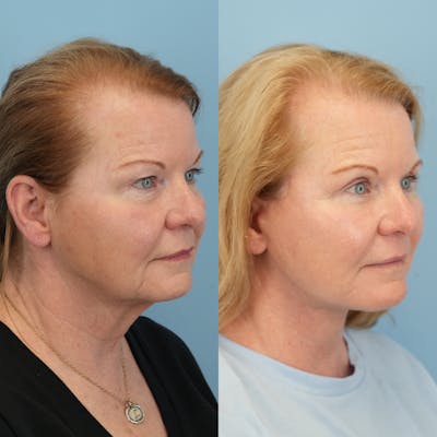 Upper Eyelids Before & After Gallery - Patient 263021 - Image 2