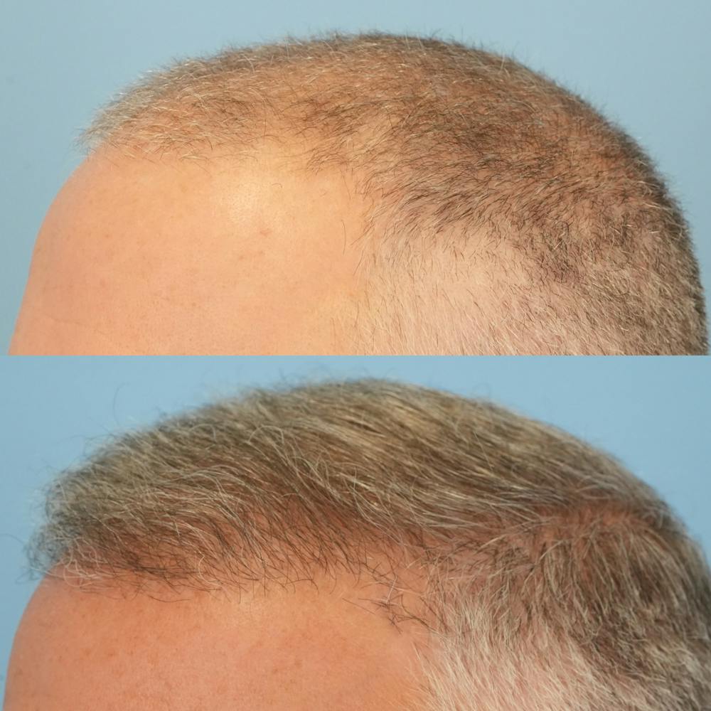 Hair Transplantation Before & After Gallery - Patient 219313 - Image 3