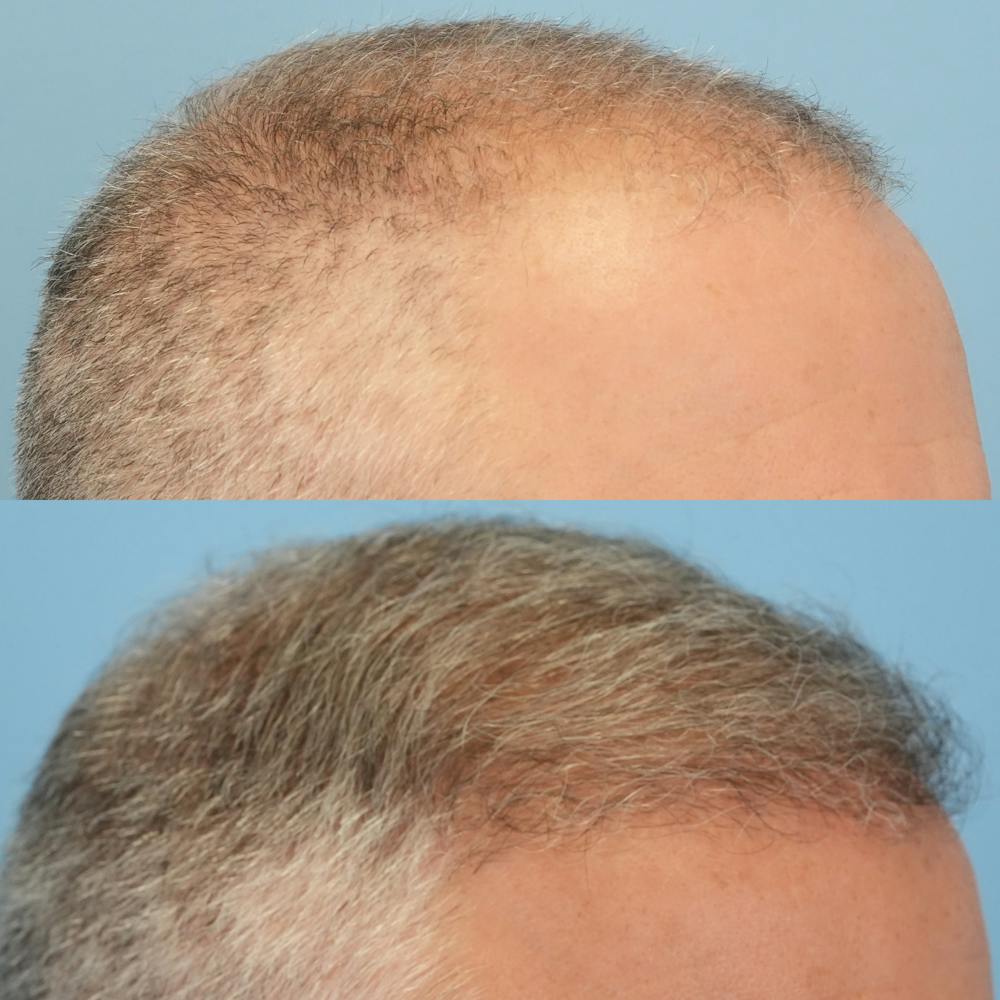 Hair Transplantation Before & After Gallery - Patient 219313 - Image 2