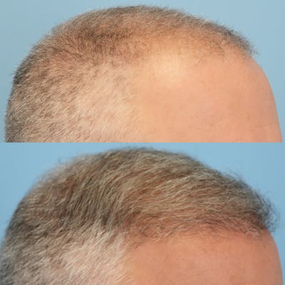 Hair Transplantation Before & After Gallery - Patient 219313 - Image 2