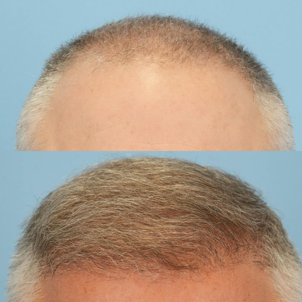 Hair Transplantation Before & After Gallery - Patient 219313 - Image 1